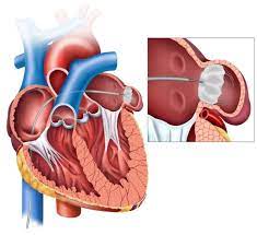 The Watchman Procedure: Promoting Long-Term Cardiac Wellness post thumbnail image