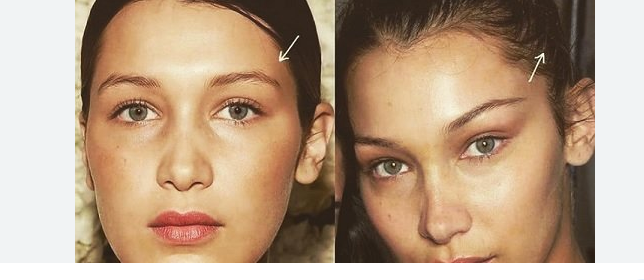 Get yourself a Typical Seem with Cheek Filler Remedies post thumbnail image