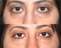 Rejuvenate Your Look: Santa Barbara’s Top Blepharoplasty Specialists post thumbnail image