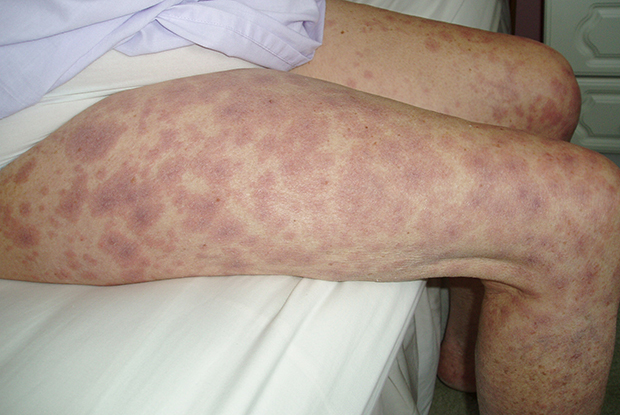 Understanding Vasculitis: A Guide to Diagnosing and Managing the Condition post thumbnail image