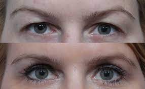 Together with the Blepharoplasty Santa Barbara, you should have a youthful, much more radiant face post thumbnail image
