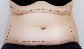 Achieve Your Fat Loss Goals with a Tummy Tuck in Miami post thumbnail image