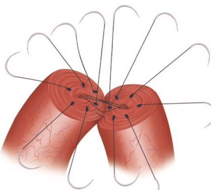 Preparing for Vasectomy Reversal: What to Know post thumbnail image