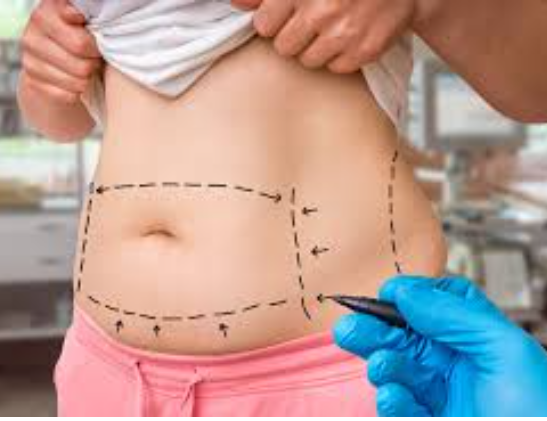 Sculpting Serenity: The Art and Science of Abdominoplasty in Miami post thumbnail image