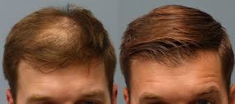 Toronto’s Elite Hair Transplant Experts: Where Technology Meets Artistry post thumbnail image